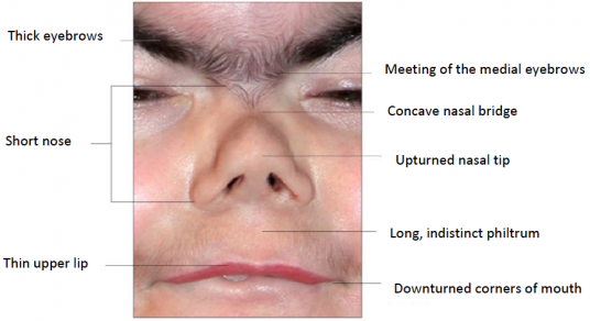 What are the Physical Characteristics of Cornelia de Lange Syndrome